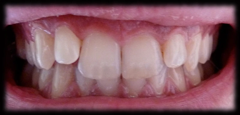 après brossage avec ma Braun Oral b